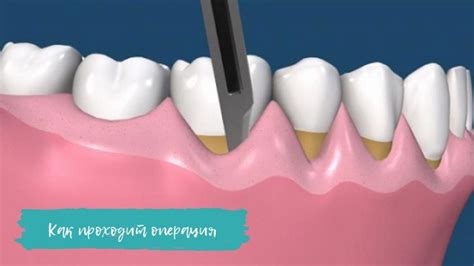 Пластика десны (гингивопластика): как избавиться от темной шейки ...