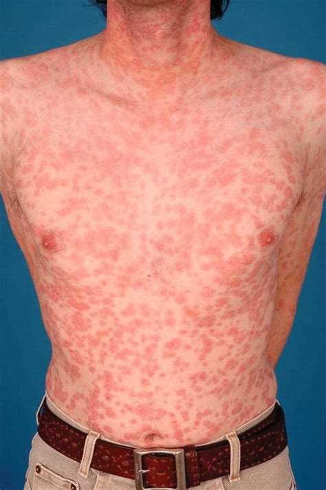 The rash of secondary syphilis | CMAJ