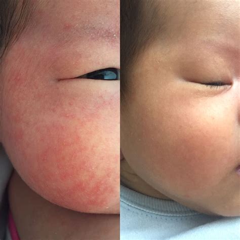 Atopic Dermatitis On Face