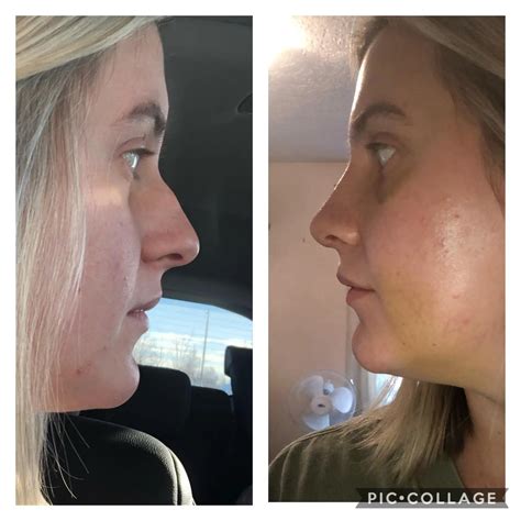 Before and after update | Scrolller