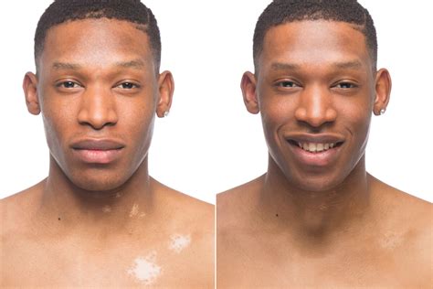 Vitiligo Makeup Before And After | Saubhaya Makeup