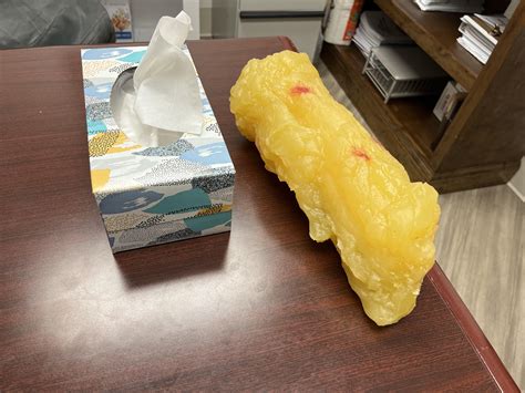 5 Pounds Of Fat
