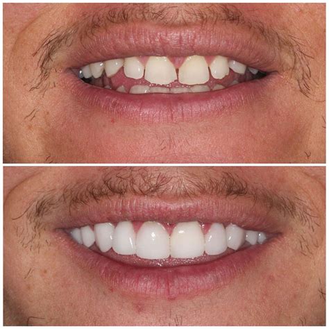 Teeth Veneers Before And After