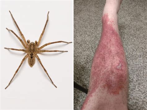 Spider Bite This Is What A Brown Recluse Spider Bite Looks Like Early ...