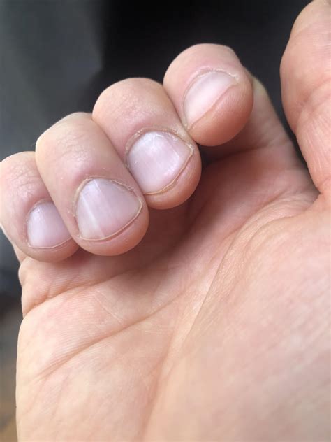 Upcoming nail biopsy : r/DermatologyQuestions