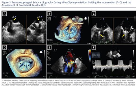 Figure 3: Transoesophageal Echocardiography During MitraClip ...