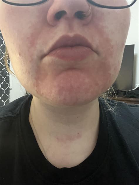 Does this look like eczema or dermatitis? : r/DermatologyQuestions