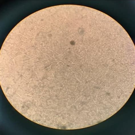 Gram staining showing numerous pus cells with intracellular