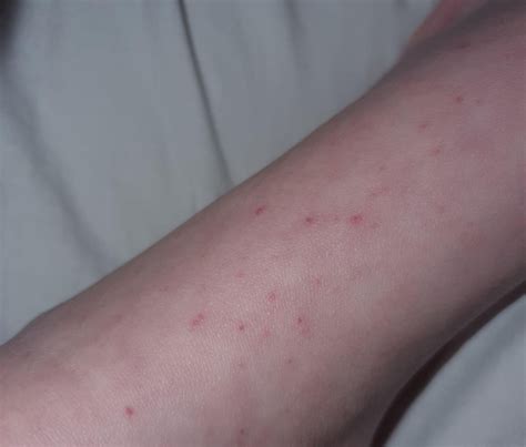 itchy spots  popped    weeks  rdermatologyquestions