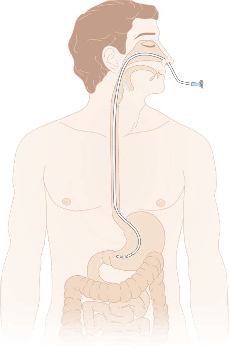 Зонды для гастроэнтерологии - Блог mystoma.ru