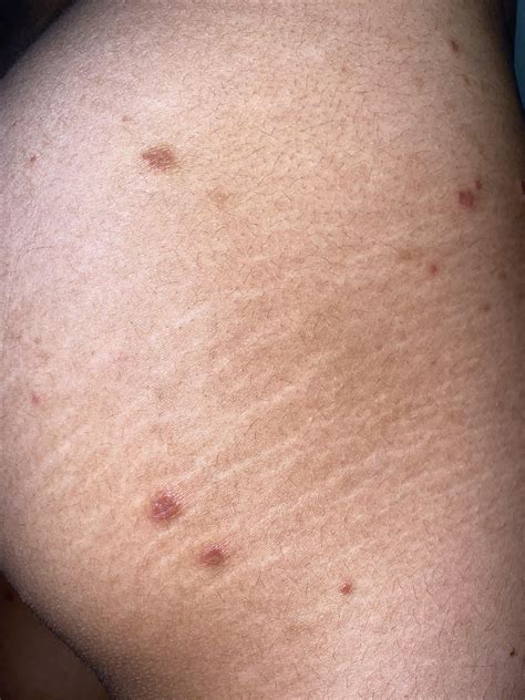 My Derm isn’t much help. Any ideas if reinfestation or post scabies
