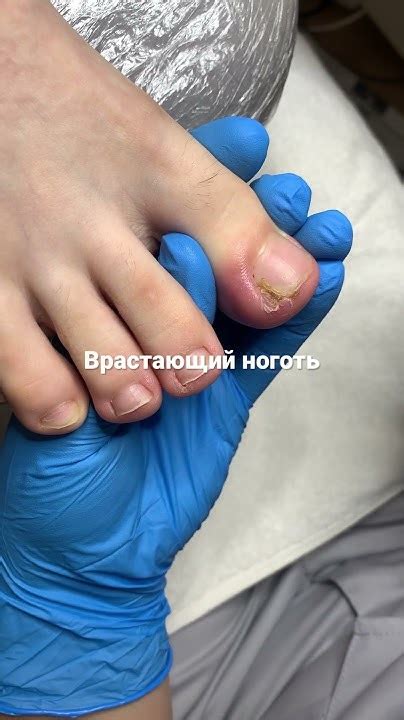 Врастающий ноготь - YouTube