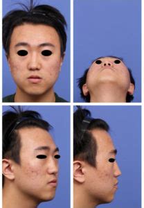 manage deviated nose personal tips rhinoplasty archive