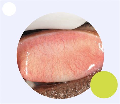 Trachoma Photo Database
