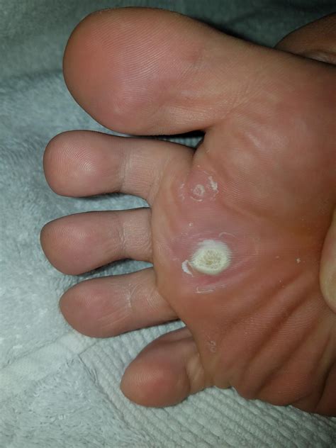 Foot Corn Vs Wart Pictures at Yi Voss blog