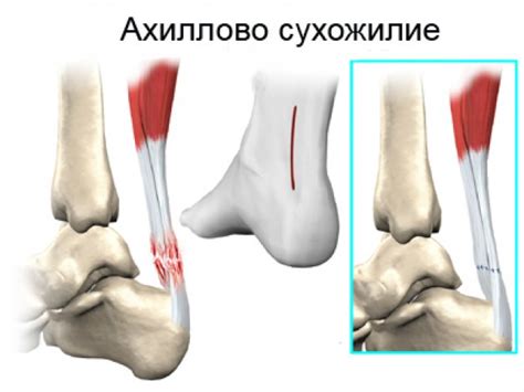 Ахиллово сухожилие: фото, где находится, анатомия и лечение