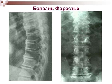 Рентгенодиагностика дистрофических изменений элементов позвоночного ...
