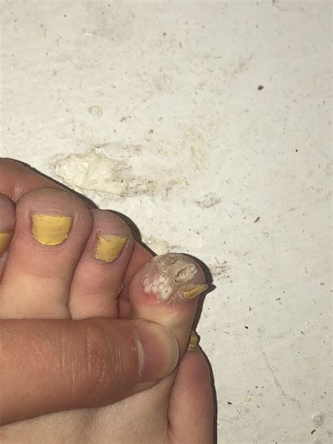 I’m scared of my toe : Warts