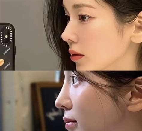 Shocking Nose Surgery Trend Explodes In Popularity - Koreaboo