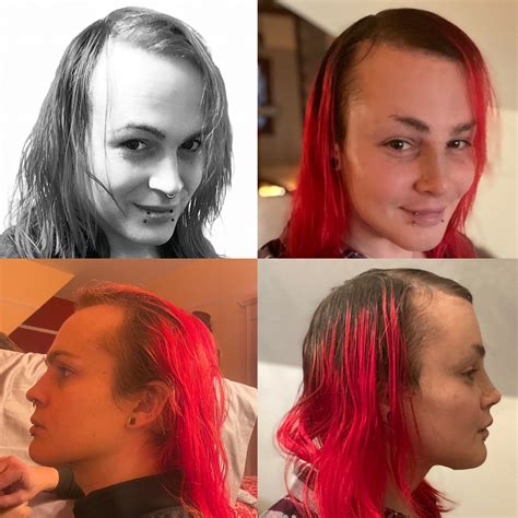 2064 best r/transgender_surgeries images on Pholder | FFS