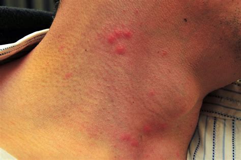 How Does Bed Bug Bites Look Like at Lloyd Sutton blog