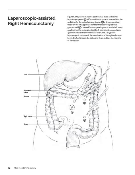 Right Hemicolectomy | chelseacanlas