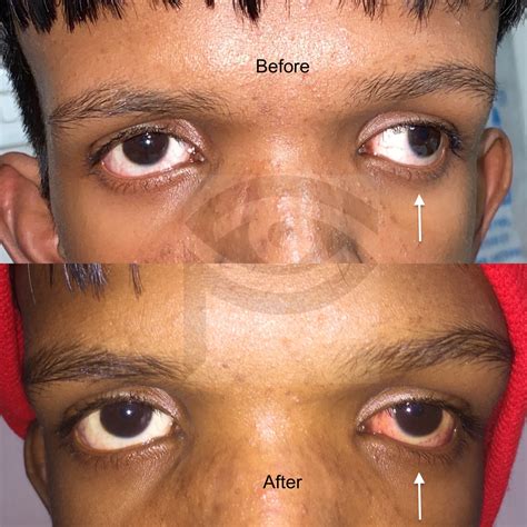 Before After - Dr. Pallavi Singh - MD, FICO