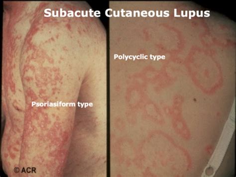 Systemic Lupus Erythematosus Flashcards | Quizlet