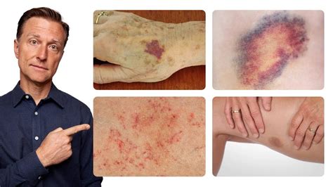 The Deeper Causes Of BRUISING (Non-Injury Type)