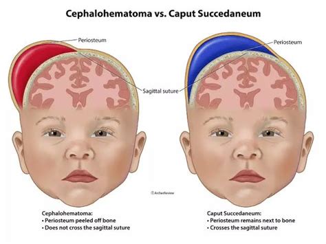 caput succedaneum  cephalohematoma difference