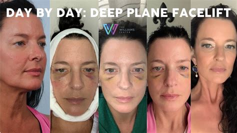 Day by Day Deep Plane Facelift Recovery: Three Months Post-Op - YouTube