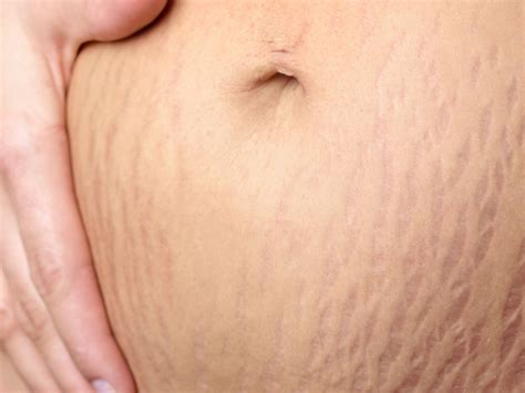 stretch marks cover up tattoo 3