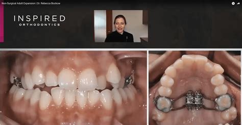 Seattle Orthodontist - Non-Surgical Adult Expansion - News - Inspired