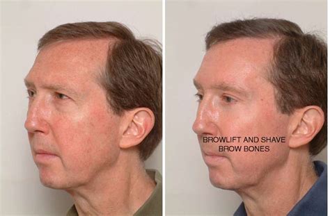 facial bone reduction dr james romano