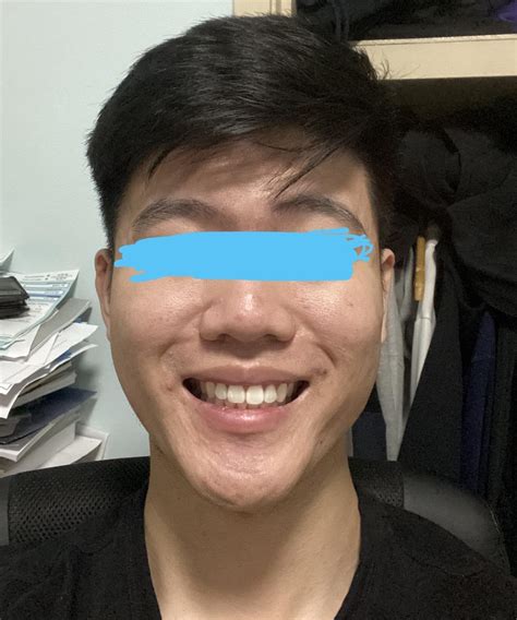 Always felt my smile+teeth is off. Looks uneven to me. I want to seek