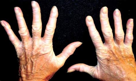 Transgredient palmoplantar hyperkeratosis | Download Scientific Diagram