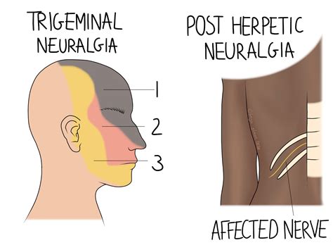 Neuralgia