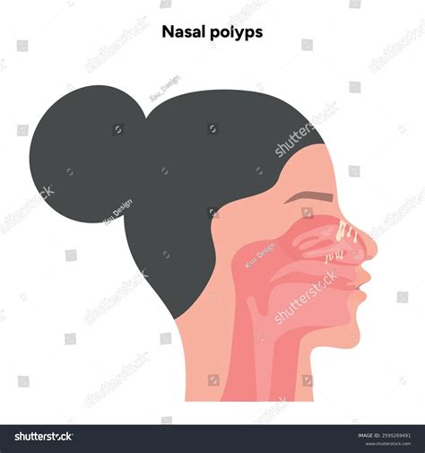 Nasal Polyps Nose Disease Diagnostic Treatment Stock Vector (Royalty