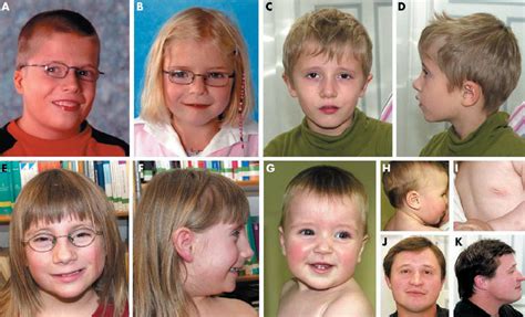 deletion syndrome facial features kksurc