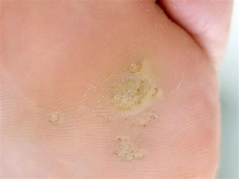 Plantar callus: Symptoms, causes, and how to remove them