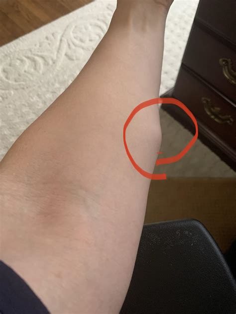 Lump In Forearm Causing Pain at Sarita Sturgeon blog