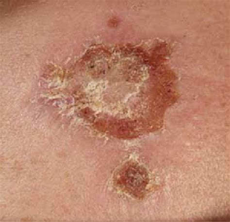 Crust Skin