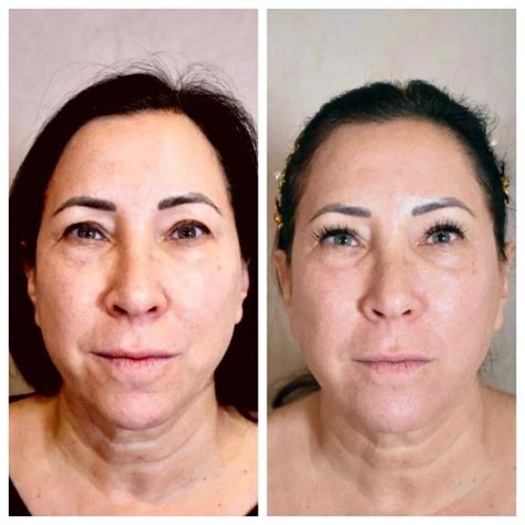 Radio Frequency Face Lift Montreal | Reimagine Clinic