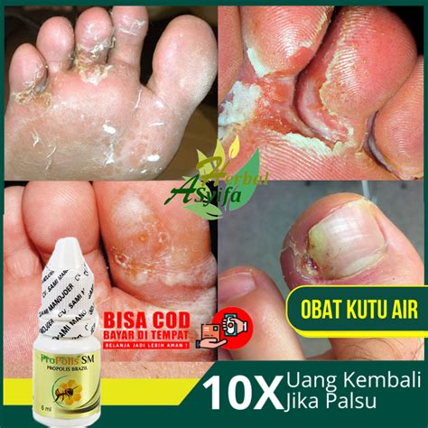 obat kutu air obat  kutu air penghilang kuman air jamur kutu