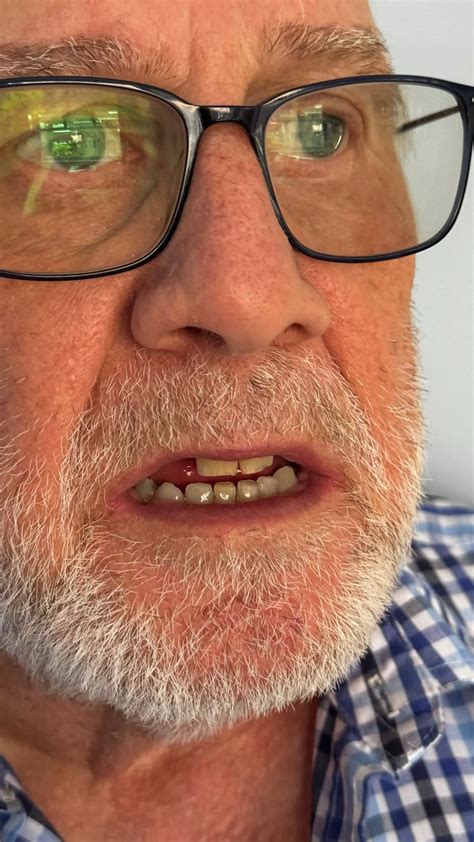 'I went for a root canal and now my life expectancy may be cut by five