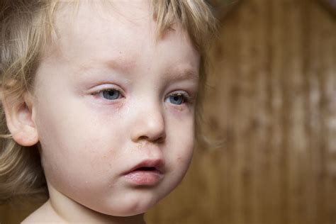 understanding pink eye symptoms   treatment