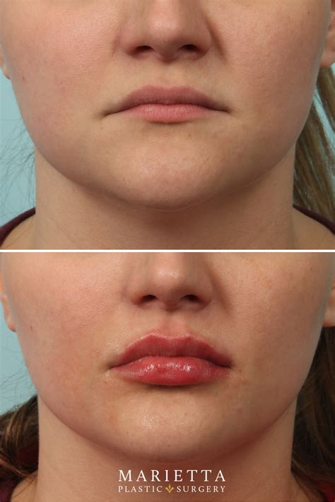Before & After: Juvederm Lip Filler | Lip fillers, Dermal fillers ...