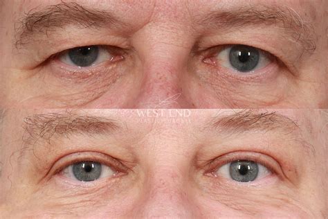 Upper Eyelid Lift & Brow Lift (3 Months Post-op) Before & After Gallery
