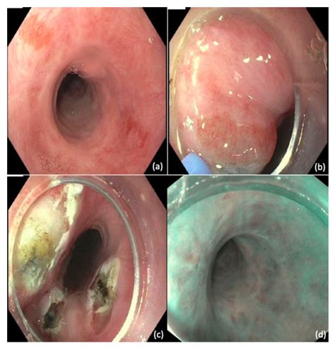 Esophagus Cancer Endoscopy
