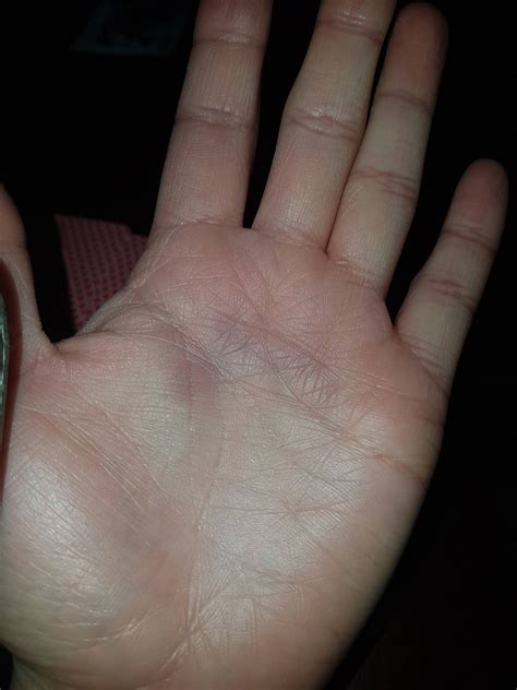 Purple spot on palm of hand. Similar but smaller spot on other hand